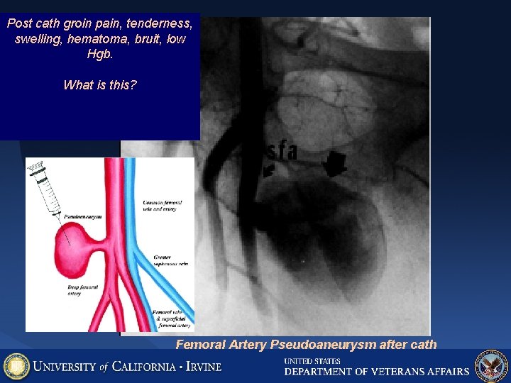 Post cath groin pain, tenderness, swelling, hematoma, bruit, low Hgb. What is this? Femoral