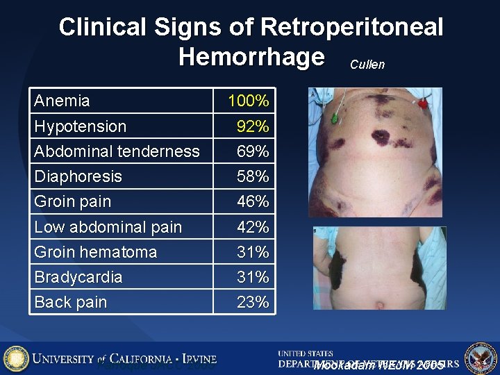 Clinical Signs of Retroperitoneal Hemorrhage Cullen Anemia 100% Hypotension Abdominal tenderness 92% 69% Diaphoresis Clinical Signs of Retroperitoneal Hemorrhage Cullen Anemia 100% Hypotension Abdominal tenderness 92% 69% Diaphoresis