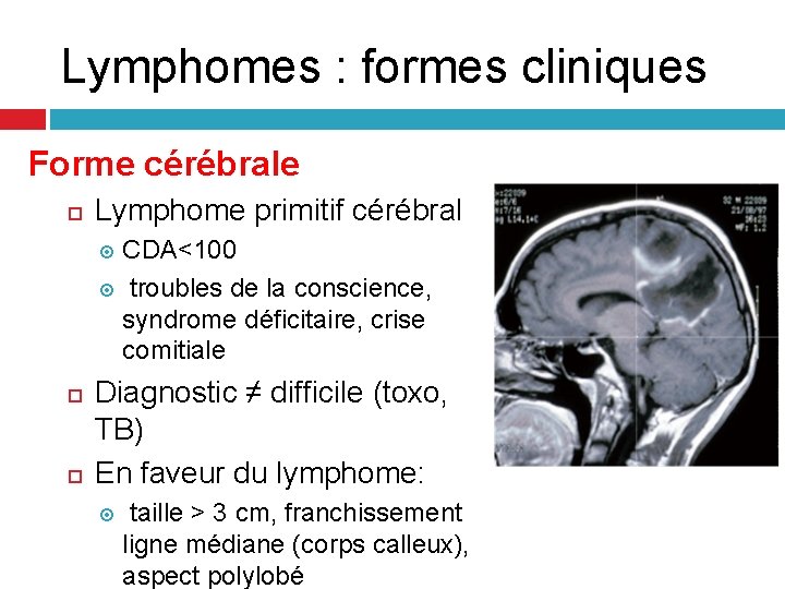 Lymphomes : formes cliniques Forme cérébrale Lymphome primitif cérébral CDA<100 troubles de la conscience, Lymphomes : formes cliniques Forme cérébrale Lymphome primitif cérébral CDA<100 troubles de la conscience,