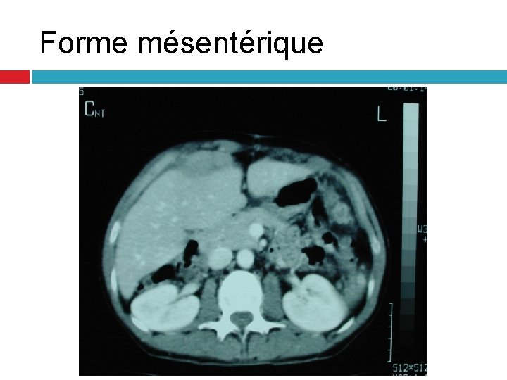 Forme mésentérique Forme mésentérique