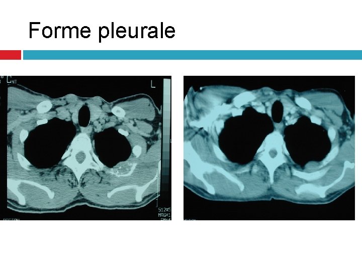 Forme pleurale Forme pleurale