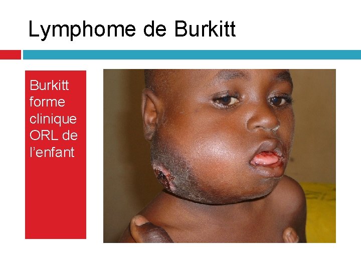 Lymphome de Burkitt forme clinique ORL de l’enfant Lymphome de Burkitt forme clinique ORL de l’enfant
