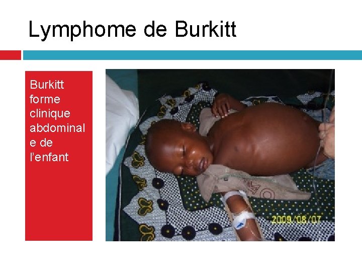 Lymphome de Burkitt forme clinique abdominal e de l’enfant Lymphome de Burkitt forme clinique abdominal e de l’enfant