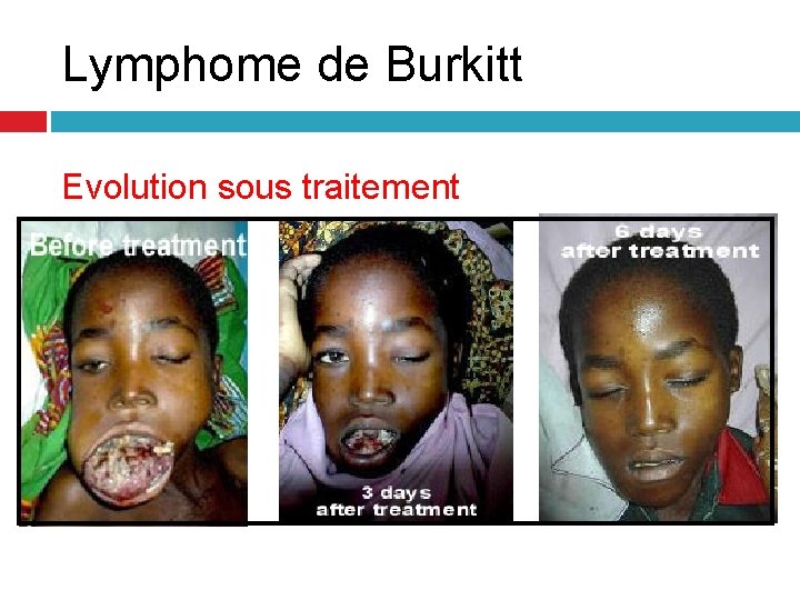 Lymphome de Burkitt Evolution sous traitement Lymphome de Burkitt Evolution sous traitement