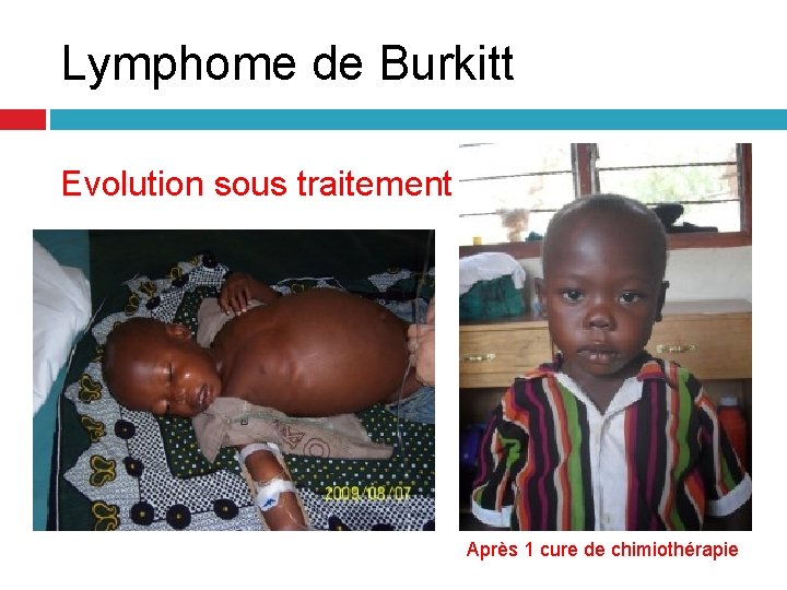 Lymphome de Burkitt Evolution sous traitement Après 1 cure de chimiothérapie Lymphome de Burkitt Evolution sous traitement Après 1 cure de chimiothérapie