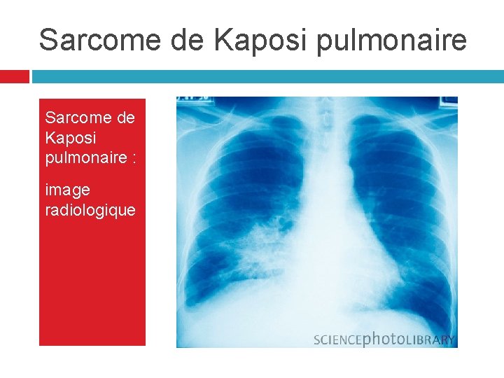 Sarcome de Kaposi pulmonaire : image radiologique Sarcome de Kaposi pulmonaire : image radiologique