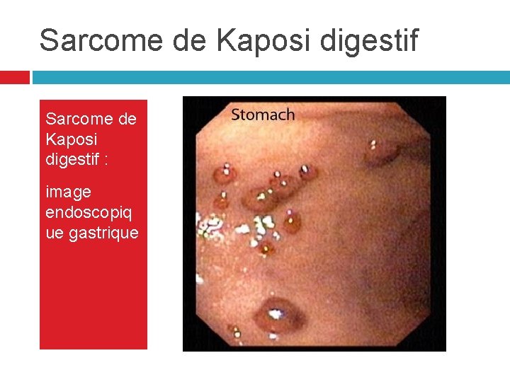 Sarcome de Kaposi digestif : image endoscopiq ue gastrique Sarcome de Kaposi digestif : image endoscopiq ue gastrique
