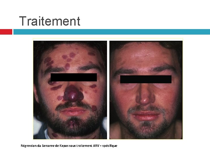 Traitement Régression du Sarcome de Kapos sous traitement ARV + spécifique Traitement Régression du Sarcome de Kapos sous traitement ARV + spécifique