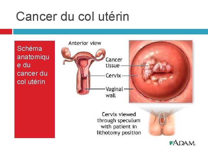 Cancer du col utérin Schéma anatomiqu e du cancer du col utérin Cancer du col utérin Schéma anatomiqu e du cancer du col utérin