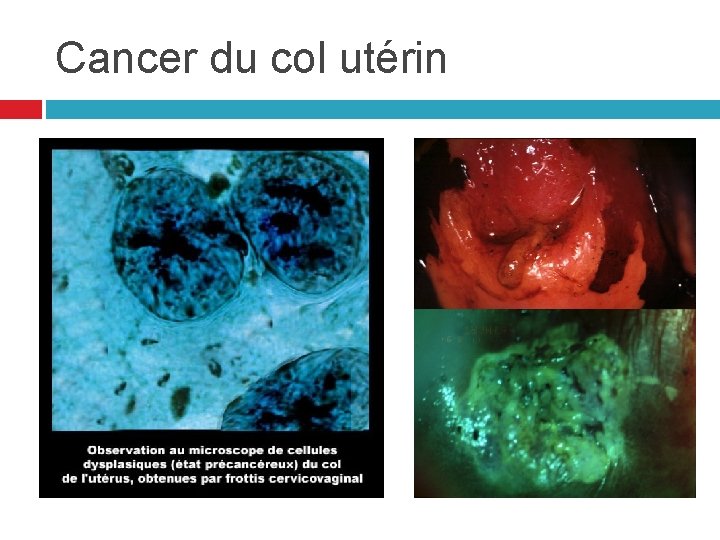 Cancer du col utérin Cancer du col utérin