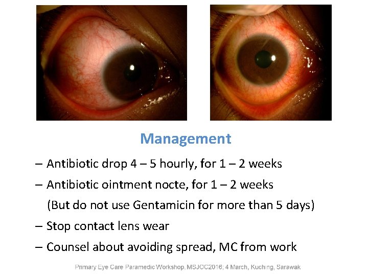 Management – Antibiotic drop 4 – 5 hourly, for 1 – 2 weeks –