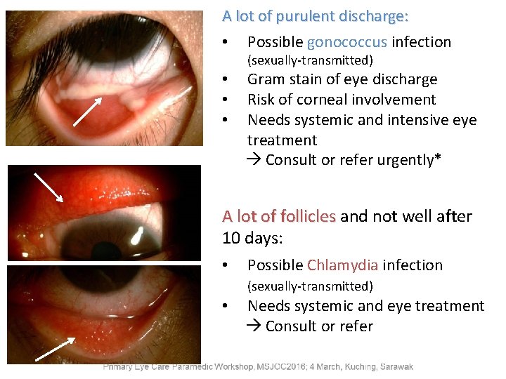 A lot of purulent discharge: • Possible gonococcus infection (sexually-transmitted) • • • Gram