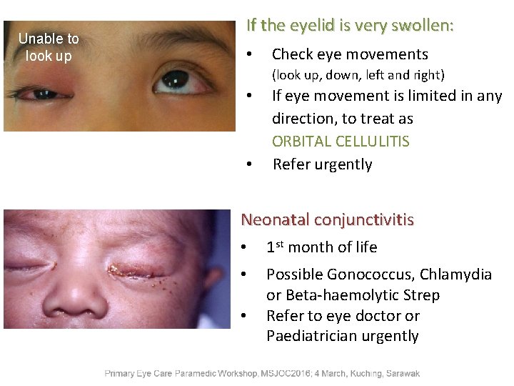 Unable to look up If the eyelid is very swollen: • Check eye movements
