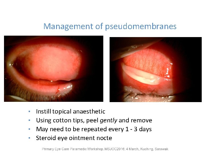 Management of pseudomembranes Instill topical anaesthetic • Using cotton tips, peel gently and remove