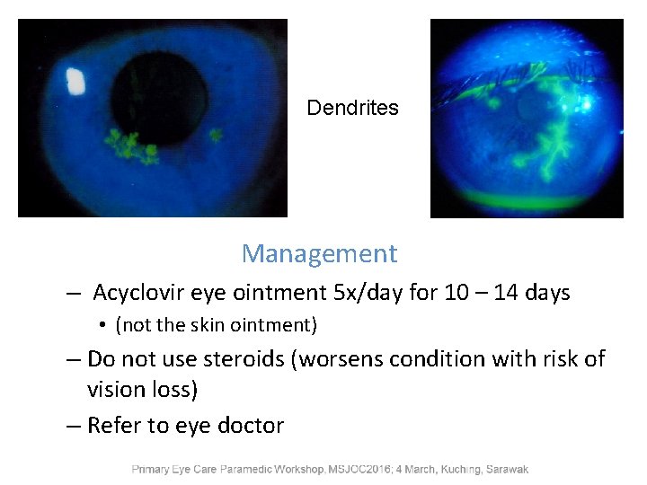 Dendrites Management – Acyclovir eye ointment 5 x/day for 10 – 14 days •