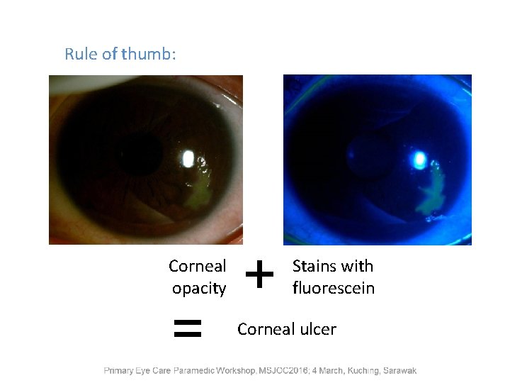 Rule of thumb: Corneal opacity = + Stains with fluorescein Corneal ulcer 