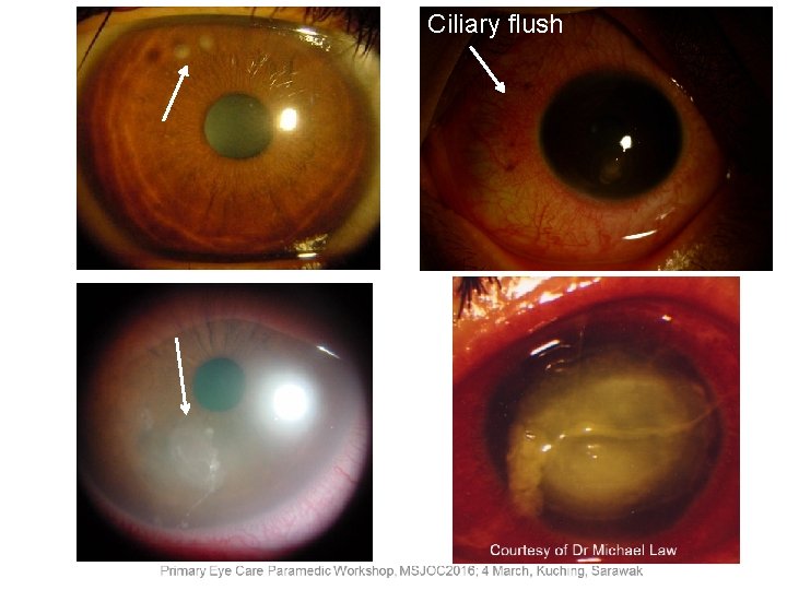 Ciliary flush Courtesy of Dr Michael Law 