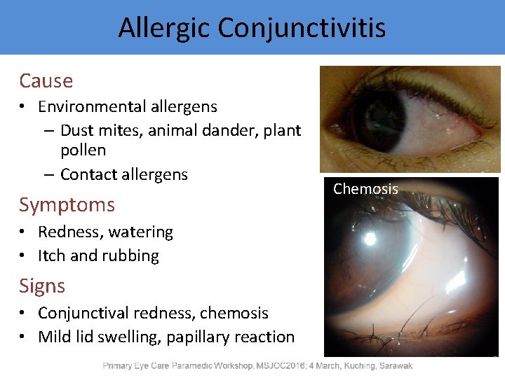 Allergic Conjunctivitis Cause • Environmental allergens – Dust mites, animal dander, plant pollen –
