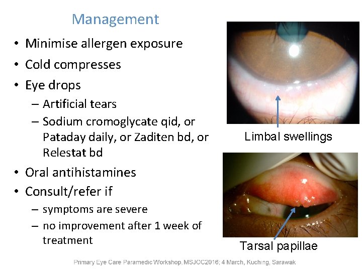 Management • Minimise allergen exposure • Cold compresses • Eye drops – Artificial tears