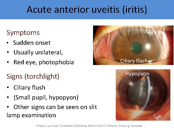 Acute anterior uveitis (iritis) Symptoms • Sudden onset • Usually unilateral, • Red eye,
