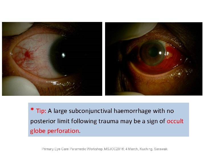 * Tip: A large subconjunctival haemorrhage with no posterior limit following trauma may be