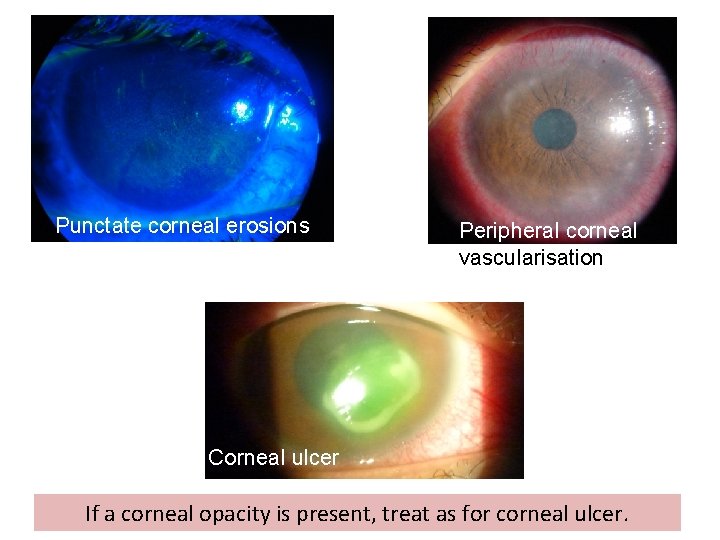 Punctate corneal erosions Peripheral corneal vascularisation Corneal ulcer If a corneal opacity is present,