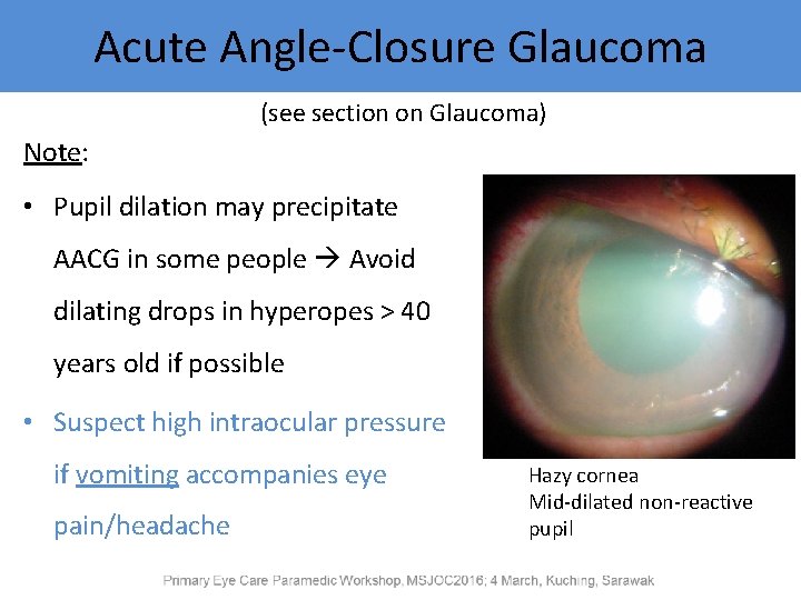 Acute Angle-Closure Glaucoma (see section on Glaucoma) Note: • Pupil dilation may precipitate AACG