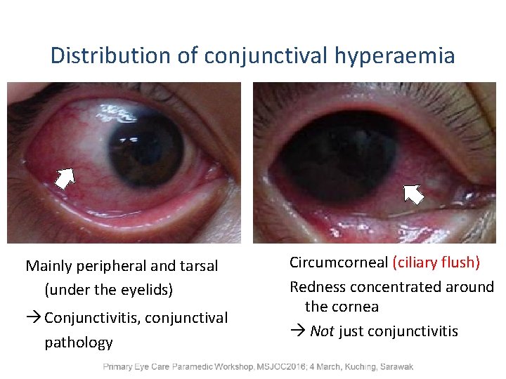 Distribution of conjunctival hyperaemia Mainly peripheral and tarsal (under the eyelids) Conjunctivitis, conjunctival pathology