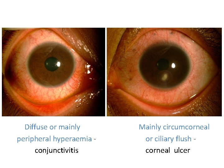 1 Diffuse or mainly peripheral hyperaemia conjunctivitis Mainly circumcorneal or ciliary flush corneal ulcer