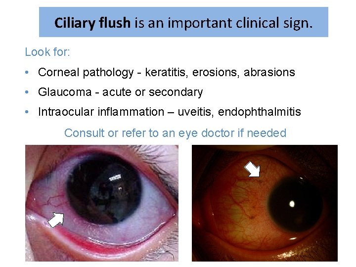 Ciliary flush is an important clinical sign. Look for: • Corneal pathology - keratitis,