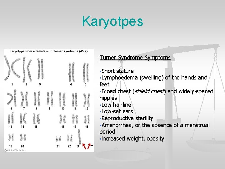 Karyotpes Turner Syndrome Symptoms §Short stature §Lymphoedema (swelling) of the hands and feet §Broad