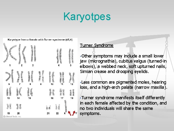 Karyotpes Turner Syndrome §Other symptoms may include a small lower jaw (micrognathia), cubitus valgus