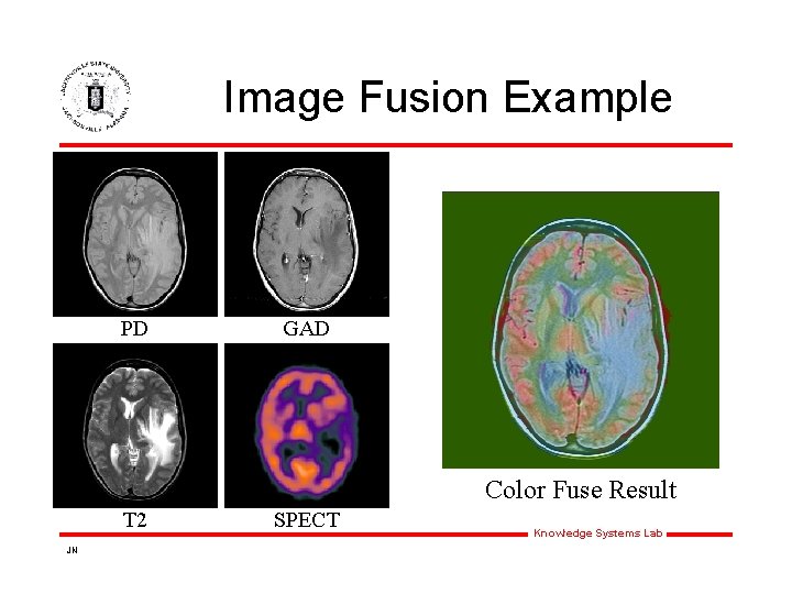 Image Fusion Example PD GAD Color Fuse Result T 2 JN SPECT Knowledge Systems Image Fusion Example PD GAD Color Fuse Result T 2 JN SPECT Knowledge Systems
