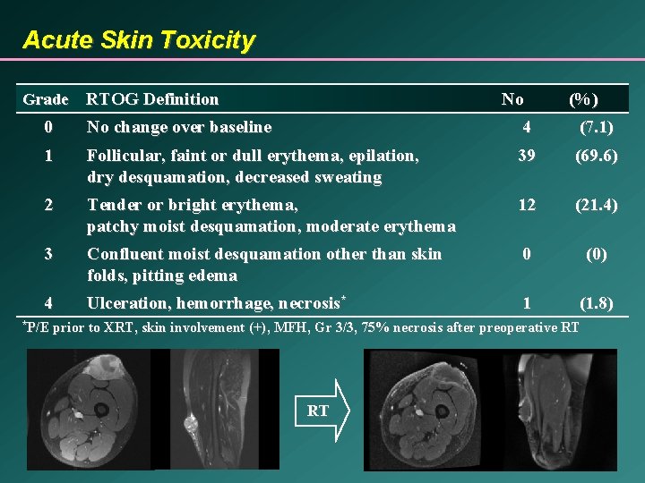 Acute Skin Toxicity Grade RTOG Definition No (%) 0 No change over baseline 4