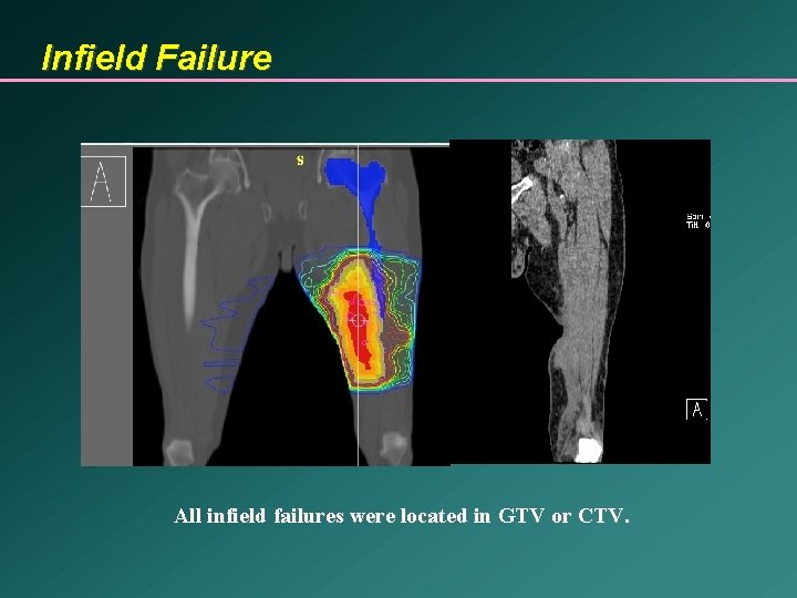 Infield Failure All infield failures were located in GTV or CTV. 