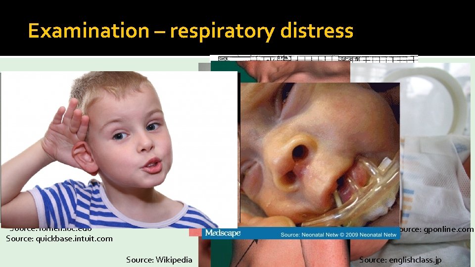 Examination – respiratory distress � Tachypnoea / tachycardia � Accessory muscles � Intercostal recessions