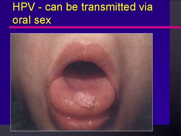 HPV - can be transmitted via oral sex HPV - can be transmitted via oral sex