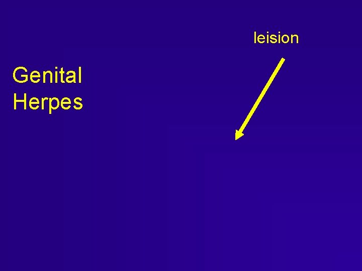 leision Genital Herpes leision Genital Herpes