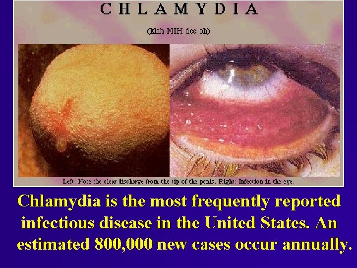 Chlamydia is the most frequently reported infectious disease in the United States. An estimated Chlamydia is the most frequently reported infectious disease in the United States. An estimated