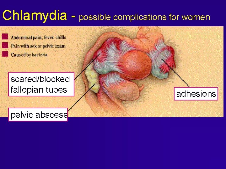 Chlamydia - possible complications for women scared/blocked fallopian tubes pelvic abscess adhesions Chlamydia - possible complications for women scared/blocked fallopian tubes pelvic abscess adhesions