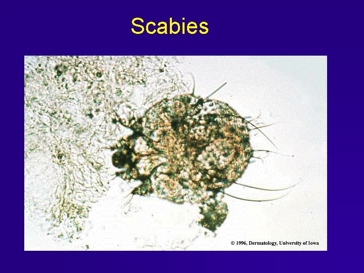 Scabies Scabies