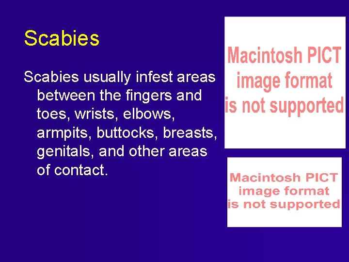 Scabies usually infest areas between the fingers and toes, wrists, elbows, armpits, buttocks, breasts, Scabies usually infest areas between the fingers and toes, wrists, elbows, armpits, buttocks, breasts,