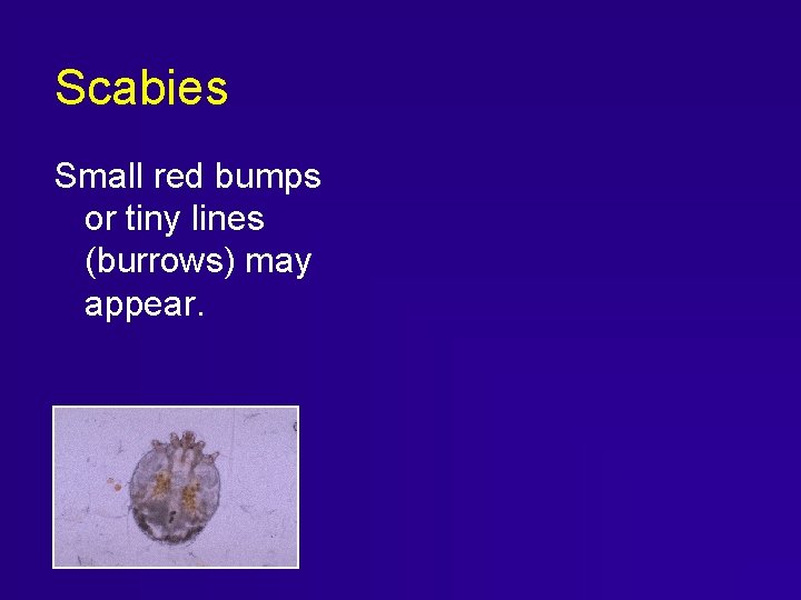Scabies Small red bumps or tiny lines (burrows) may appear. Scabies Small red bumps or tiny lines (burrows) may appear.