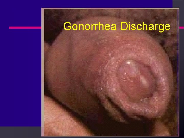 Gonorrhea Discharge Gonorrhea Discharge
