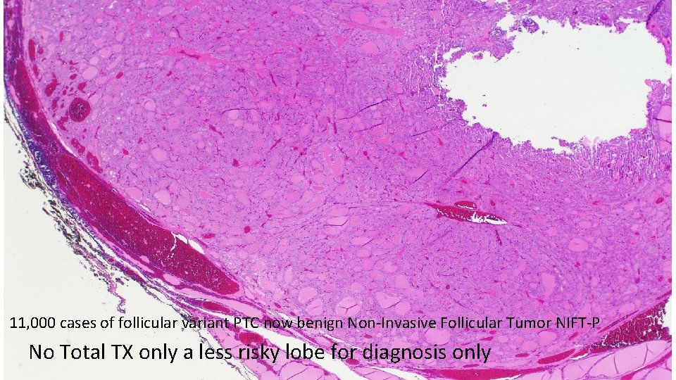 11, 000 cases of follicular variant PTC now benign Non-Invasive Follicular Tumor NIFT-P No