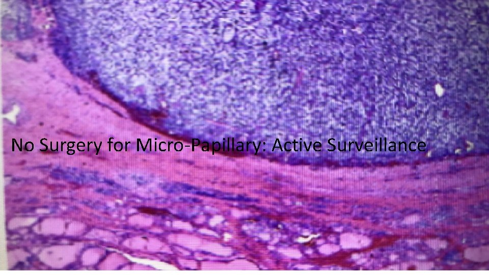 No Surgery for Micro-Papillary: Active Surveillance 