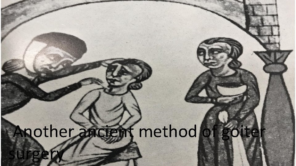 Another ancient method of goiter surgery 