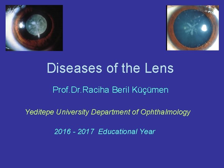Diseases of the Lens Prof. Dr. Raciha Beril Küçümen Yeditepe University Department of Ophthalmology