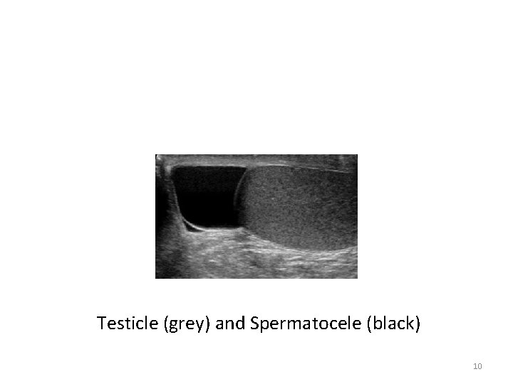 Testicle (grey) and Spermatocele (black) 10 