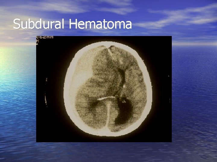 Subdural Hematoma 